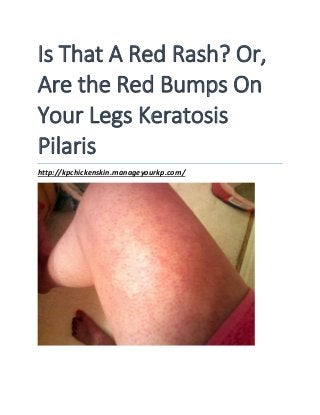 Is That A Red Rash? Or,
Are the Red Bumps On
Your Legs Keratosis
Pilaris
http://kpchickenskin.manageyourkp.com/
 