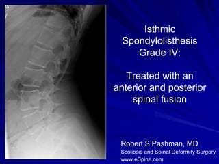 Isthmic
  Spondylolisthesis
     Grade IV:

   Treated with an
anterior and posterior
    spinal fusion



 Robert S Pashman, MD
 Scoliosis and Spinal Deformity Surgery
 www.eSpine.com
 