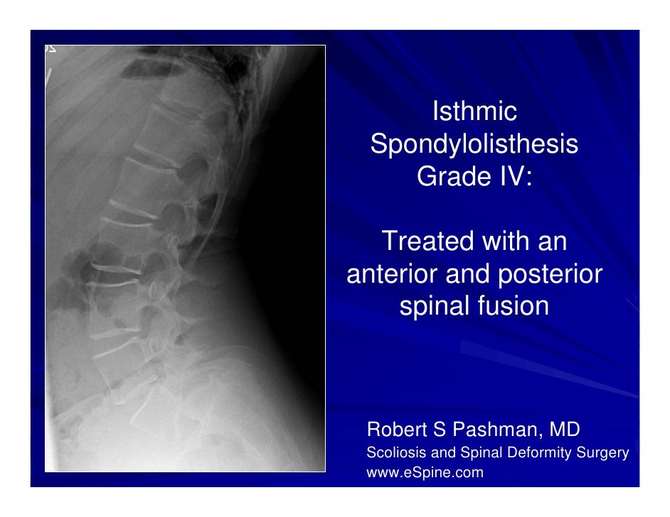 Does spondylolisthesis need surgery picture