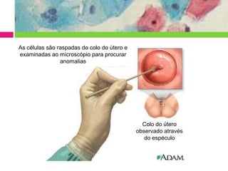 As células são raspadas do colo do útero e
examinadas ao microscópio para procurar
anomalias

Colo do útero
observado através
do espéculo

 