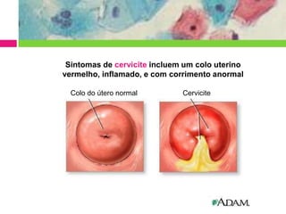 Sintomas de cervicite incluem um colo uterino
vermelho, inflamado, e com corrimento anormal
Colo do útero normal

Cervicite

 