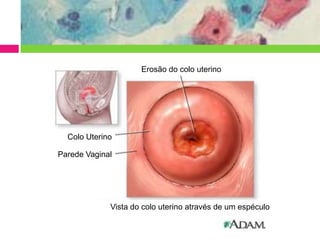 Erosão do colo uterino

Colo Uterino
Parede Vaginal

Vista do colo uterino através de um espéculo

 