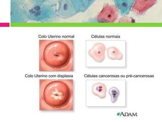 Colo Uterino normal

Colo Uterino com displasia

Células normais

Células cancerosas ou pré-cancerosas

 