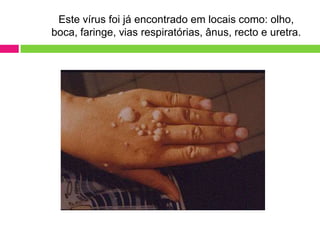 Este vírus foi já encontrado em locais como: olho,
boca, faringe, vias respiratórias, ânus, recto e uretra.

 