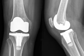 X-ray for total knee replacement