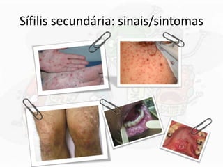 Sífilis secundária: sinais/sintomas
 