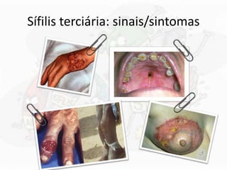 Sífilis terciária: sinais/sintomas
 