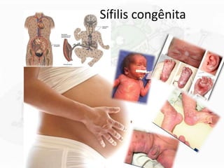 Sífilis congênita
 