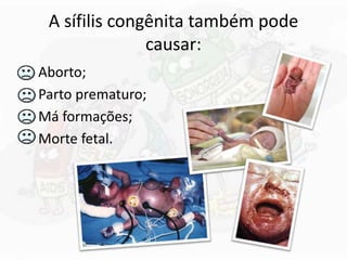 A sífilis congênita também pode
causar:
Aborto;
Parto prematuro;
Má formações;
Morte fetal.
 