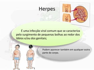 Herpes
É uma infecção viral comum que se caracteriza
pelo surgimento de pequenas bolhas ao redor dos
lábios e/ou dos genitais;
Podem aparecer também em qualquer outra
parte do corpo.
 