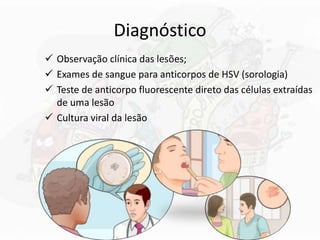 Diagnóstico
 Observação clínica das lesões;
 Exames de sangue para anticorpos de HSV (sorologia)
 Teste de anticorpo fluorescente direto das células extraídas
de uma lesão
 Cultura viral da lesão
 