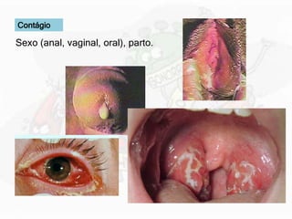 Contágio
Sexo (anal, vaginal, oral), parto.
 