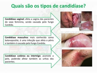 Quais são os tipos de candidíase?
Candidíase vaginal: afeta a vagina das pacientes
do sexo feminino, sendo causada pelo fungo
Candida.
Candidíase masculina: mais conhecida como
balanopostite, é uma infecção que afeta o pênis
e também é causada pelo fungo Candida.
Candidíase cutânea ou intertrigo: acomete a
pele, podendo afetar também as unhas dos
pacientes.
 