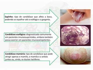 Sapinho: tipo de candidíase que afeta a boca,
podendo se espalhar até o esôfago e a garganta.
Candidíase esofágica: diagnosticada comumente
em pacientes imunossuprimidos, embora também
possa ocorrer em pacientes imunocompetentes.
Candidíase mamária: tipo de candidíase que pode
atingir apenas o mamilo, o mamilo e a aréola
juntos ou, ainda, os ductos lactíferos.
 