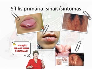 Sífilis primária: sinais/sintomas
 