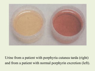Urine from a patient with porphyria cutanea tarda (right)
and from a patient with normal porphyrin excretion (left).
 