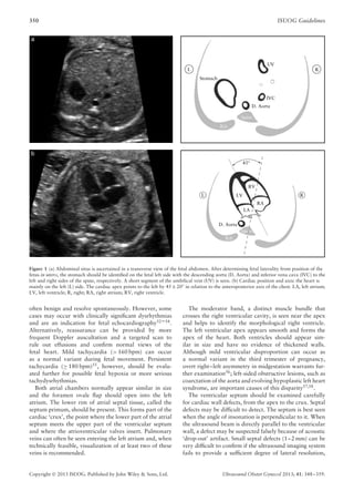 350 ISUOG Guidelines
RL
RL
Stomach
D. Aorta
Spine
Rib
Spine
Rib
UV
IVC
RV
45°
RA
LV
LA
D. Aorta
Figure 1 (a) Abdominal situs is ascertained in a transverse view of the fetal abdomen. After determining fetal laterality from position of the
fetus in utero, the stomach should be identiﬁed on the fetal left side with the descending aorta (D. Aorta) and inferior vena cava (IVC) to the
left and right sides of the spine, respectively. A short segment of the umbilical vein (UV) is seen. (b) Cardiac position and axis: the heart is
mainly on the left (L) side. The cardiac apex points to the left by 45 ± 20◦
in relation to the anteroposterior axis of the chest. LA, left atrium;
LV, left ventricle; R, right; RA, right atrium; RV, right ventricle.
often benign and resolve spontaneously. However, some
cases may occur with clinically signiﬁcant dysrhythmias
and are an indication for fetal echocardiography52–54
.
Alternatively, reassurance can be provided by more
frequent Doppler auscultation and a targeted scan to
rule out effusions and conﬁrm normal views of the
fetal heart. Mild tachycardia (> 160 bpm) can occur
as a normal variant during fetal movement. Persistent
tachycardia (≥ 180 bpm)55
, however, should be evalu-
ated further for possible fetal hypoxia or more serious
tachydysrhythmias.
Both atrial chambers normally appear similar in size
and the foramen ovale ﬂap should open into the left
atrium. The lower rim of atrial septal tissue, called the
septum primum, should be present. This forms part of the
cardiac ‘crux’, the point where the lower part of the atrial
septum meets the upper part of the ventricular septum
and where the atrioventricular valves insert. Pulmonary
veins can often be seen entering the left atrium and, when
technically feasible, visualization of at least two of these
veins is recommended.
The moderator band, a distinct muscle bundle that
crosses the right ventricular cavity, is seen near the apex
and helps to identify the morphological right ventricle.
The left ventricular apex appears smooth and forms the
apex of the heart. Both ventricles should appear sim-
ilar in size and have no evidence of thickened walls.
Although mild ventricular disproportion can occur as
a normal variant in the third trimester of pregnancy,
overt right–left asymmetry in midgestation warrants fur-
ther examination56
; left-sided obstructive lesions, such as
coarctation of the aorta and evolving hypoplastic left heart
syndrome, are important causes of this disparity57,58.
The ventricular septum should be examined carefully
for cardiac wall defects, from the apex to the crux. Septal
defects may be difﬁcult to detect. The septum is best seen
when the angle of insonation is perpendicular to it. When
the ultrasound beam is directly parallel to the ventricular
wall, a defect may be suspected falsely because of acoustic
‘drop-out’ artifact. Small septal defects (1–2 mm) can be
very difﬁcult to conﬁrm if the ultrasound imaging system
fails to provide a sufﬁcient degree of lateral resolution,
Copyright  2013 ISUOG. Published by John Wiley & Sons, Ltd. Ultrasound Obstet Gynecol 2013; 41: 348–359.
 
