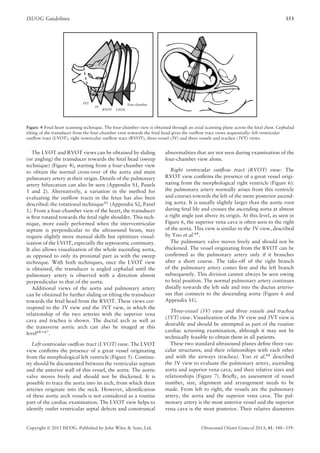 ISUOG Guidelines 353
3VT
3V
RVOT LVOT
Four-chamber
Figure 4 Fetal heart scanning technique. The four-chamber view is obtained through an axial scanning plane across the fetal chest. Cephalad
tilting of the transducer from the four-chamber view towards the fetal head gives the outﬂow tract views sequentially: left ventricular
outﬂow tract (LVOT), right ventricular outﬂow tract (RVOT), three-vessel (3V) and three vessels and trachea (3VT) views.
The LVOT and RVOT views can be obtained by sliding
(or angling) the transducer towards the fetal head (sweep
technique) (Figure 4), starting from a four-chamber view
to obtain the normal cross-over of the aorta and main
pulmonary artery at their origin. Details of the pulmonary
artery bifurcation can also be seen (Appendix S1, Panels
1 and 2). Alternatively, a variation in the method for
evaluating the outﬂow tracts in the fetus has also been
described: the rotational technique41 (Appendix S2, Panel
1). From a four-chamber view of the heart, the transducer
is ﬁrst rotated towards the fetal right shoulder. This tech-
nique, more easily performed when the interventricular
septum is perpendicular to the ultrasound beam, may
require slightly more manual skills but optimizes visual-
ization of the LVOT, especially the septoaortic continuity.
It also allows visualization of the whole ascending aorta,
as opposed to only its proximal part as with the sweep
technique. With both techniques, once the LVOT view
is obtained, the transducer is angled cephalad until the
pulmonary artery is observed with a direction almost
perpendicular to that of the aorta.
Additional views of the aorta and pulmonary artery
can be obtained by further sliding or tilting the transducer
towards the fetal head from the RVOT. These views cor-
respond to the 3V view and the 3VT view, in which the
relationship of the two arteries with the superior vena
cava and trachea is shown. The ductal arch as well as
the transverse aortic arch can also be imaged at this
level64–67
.
Left ventricular outﬂow tract (LVOT) view. The LVOT
view conﬁrms the presence of a great vessel originating
from the morphological left ventricle (Figure 5). Continu-
ity should be documented between the ventricular septum
and the anterior wall of this vessel, the aorta. The aortic
valve moves freely and should not be thickened. It is
possible to trace the aorta into its arch, from which three
arteries originate into the neck. However, identiﬁcation
of these aortic arch vessels is not considered as a routine
part of the cardiac examination. The LVOT view helps to
identify outlet ventricular septal defects and conotruncal
abnormalities that are not seen during examination of the
four-chamber view alone.
Right ventricular outﬂow tract (RVOT) view. The
RVOT view conﬁrms the presence of a great vessel origi-
nating from the morphological right ventricle (Figure 6):
the pulmonary artery normally arises from this ventricle
and courses towards the left of the more posterior ascend-
ing aorta. It is usually slightly larger than the aortic root
during fetal life and crosses the ascending aorta at almost
a right angle just above its origin. At this level, as seen in
Figure 6, the superior vena cava is often seen to the right
of the aorta. This view is similar to the 3V view, described
by Yoo et al.64.
The pulmonary valve moves freely and should not be
thickened. The vessel originating from the RVOT can be
conﬁrmed as the pulmonary artery only if it branches
after a short course. The take-off of the right branch
of the pulmonary artery comes ﬁrst and the left branch
subsequently. This division cannot always be seen owing
to fetal position. The normal pulmonary artery continues
distally towards the left side and into the ductus arterio-
sus that connects to the descending aorta (Figure 6 and
Appendix S1).
Three-vessel (3V) view and three vessels and trachea
(3VT) view. Visualization of the 3V view and 3VT view is
desirable and should be attempted as part of the routine
cardiac screening examination, although it may not be
technically feasible to obtain them in all patients.
These two standard ultrasound planes deﬁne three vas-
cular structures, and their relationships with each other
and with the airways (trachea). Yoo et al.64
described
the 3V view to evaluate the pulmonary artery, ascending
aorta and superior vena cava, and their relative sizes and
relationships (Figure 7). Brieﬂy, an assessment of vessel
number, size, alignment and arrangement needs to be
made. From left to right, the vessels are the pulmonary
artery, the aorta and the superior vena cava. The pul-
monary artery is the most anterior vessel and the superior
vena cava is the most posterior. Their relative diameters
Copyright  2013 ISUOG. Published by John Wiley & Sons, Ltd. Ultrasound Obstet Gynecol 2013; 41: 348–359.
 