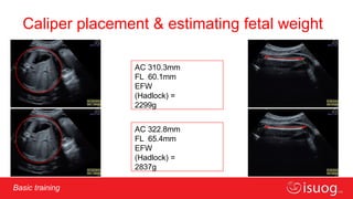 Comprehensive ISUOG Basic Training on Fetal Biometry: Dating, Size ...