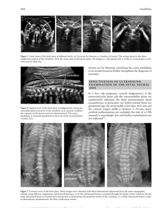 114 Guidelines
Figure 5 Axial views of the fetal spine at different levels. (a) Cervical; (b) thoracic; (c) lumbar; (d) sacral. The arrows point to the three
ossiﬁcation centers of the vertebrae. Note the intact skin overlying the spine. On images a–c the spinal cord is visible as a hypoechoic ovoid
with central white dot.
Figure 6 Sagittal view of the fetal spine at midgestation. Using the
unossiﬁed spinous process of the vertebrae as an acoustic window,
the contents of the neural canal are demonstrated. The conus
medullaris is normally positioned at the level of the second lumbar
vertebra (L2).
section can be obtained, visualizing the conus medullaris
in its normal location further strengthens the diagnosis of
normalcy.
EFFECTIVENESS OF ULTRASOUND
EXAMINATION OF THE FETAL NEURAL
AXIS
In a low risk pregnancy around midgestation, if the
transventricular plane and the transcerebellar plane are
satisfactorily obtained, the head measurements (head
circumference in particular) are within normal limits for
gestational age, the atrial width is less than 10.0 mm and
the cisterna magna width is between 2–10 mm, many
cerebral malformations are excluded, the risk of a CNS
anomaly is exceedingly low and further examinations are
not indicated17
.
Figure 7 Coronal views of the fetal spine. These images were obtained with three-dimensional ultrasound from the same sonographic
volume using different angulations and beam-thicknesses. (a) A thin ultrasound beam is oriented through the bodies of the vertebrae; (b) the
same ultrasound beam is oriented more posteriorly to demonstrate the posterior arches of the vertebrae; (c) a thick ultrasound beam is used
to demonstrate simultaneously the three ossiﬁcation centers.
 