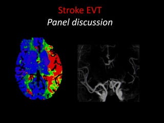 Stroke EVT
Panel discussion
 