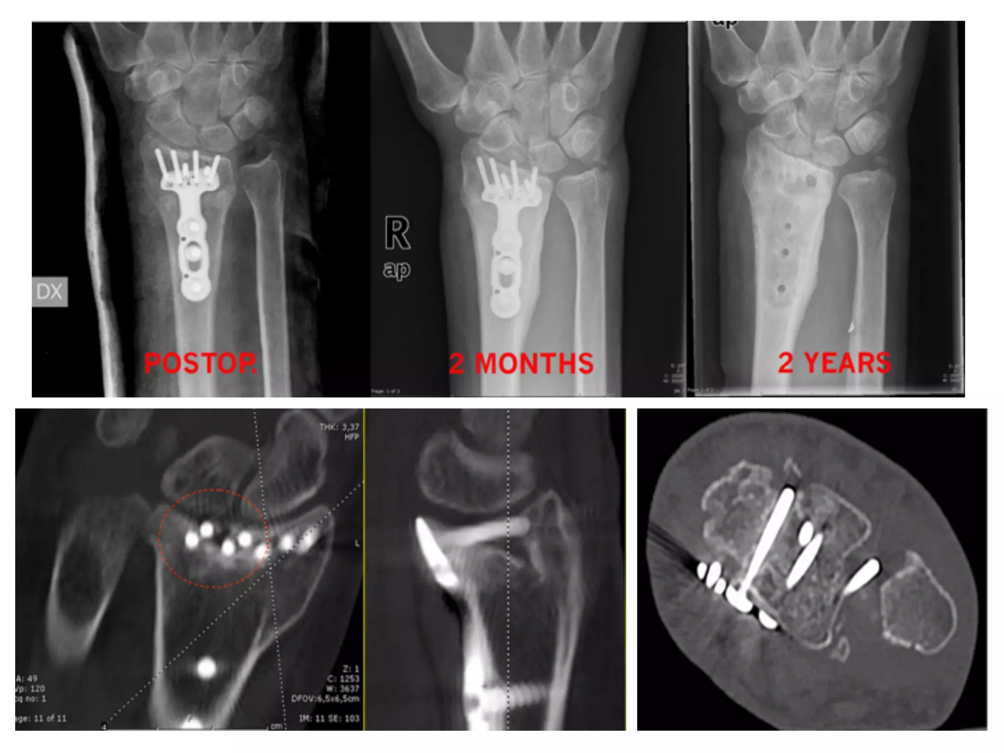 Colles Fracture Plate Is volar locking plate better than kwiring for colles fractures | PDF