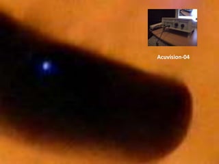 Acuvision-04
 