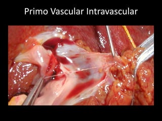Primo Vascular Intravascular
 