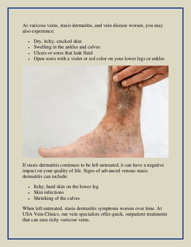 Itchy varicose veins why do they itch &a how to treat them