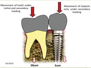 Implant tooth connection | PPTX