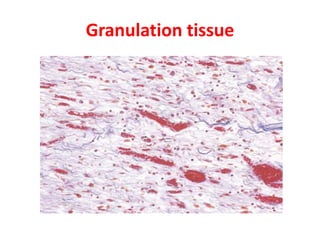 Granulation tissue
 