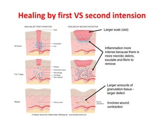 Healing by first VS second intension
 