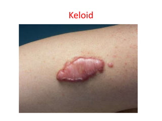 Keloid
 