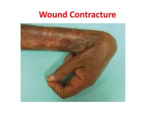 Wound Contracture
 