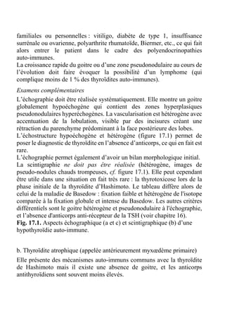 familiales ou personnelles : vitiligo, diabète de type 1, insuffisance 
surrénale ou ovarienne, polyarthrite rhumatoïde, Biermer, etc., ce qui fait 
alors entrer le patient dans le cadre des polyendocrinopathies 
auto-immunes. 
La croissance rapide du goitre ou d’une zone pseudonodulaire au cours de 
l’évolution doit faire évoquer la possibilité d’un lymphome (qui 
complique moins de 1 % des thyroïdites auto-immunes). 
Examens complémentaires 
L’échographie doit être réalisée systématiquement. Elle montre un goitre 
globalement hypoéchogène qui contient des zones hyperplasiques 
pseudonodulaires hyperéchogènes. La vascularisation est hétérogène avec 
accentuation de la lobulation, visible par des incisures créant une 
rétraction du parenchyme prédominant à la face postérieure des lobes. 
L’échostructure hypoéchogène et hétérogène (figure 17.1) permet de 
poser le diagnostic de thyroïdite en l’absence d’anticorps, ce qui en fait est 
rare. 
L’échographie permet également d’avoir un bilan morphologique initial. 
La scintigraphie ne doit pas être réalisée (hétérogène, images de 
pseudo-nodules chauds trompeuses, cf. figure 17.1). Elle peut cependant 
être utile dans une situation en fait très rare : la thyrotoxicose lors de la 
phase initiale de la thyroïdite d’Hashimoto. Le tableau diffère alors de 
celui de la maladie de Basedow : fixation faible et hétérogène de l'isotope 
comparée à la fixation globale et intense du Basedow. Les autres critères 
différentiels sont le goitre hétérogène et pseudonodulaire à l'échographie, 
et l’absence d'anticorps anti-récepteur de la TSH (voir chapitre 16). 
Fig. 17.1. Aspects échographique (a et c) et scintigraphique (b) d’une 
hypothyroïdie auto-immune. 
b. Thyroïdite atrophique (appelée antérieurement myxoedème primaire) 
Elle présente des mécanismes auto-immuns communs avec la thyroïdite 
de Hashimoto mais il existe une absence de goitre, et les anticorps 
antithyroïdiens sont souvent moins élevés. 
 