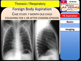 ITE Review

Thoracic / Respiratory

Foreign Body Aspiration
CASE STUDY: 7 MONTH OLD CHILD
COUGHING FOR 1 HR AFTER CHOKING EPISODE

FB Aspiration

Basics
Imaging

 