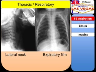 ITE Review

Thoracic / Respiratory

FB Aspiration

Basics
Imaging

Lateral neck

Expiratory film

 