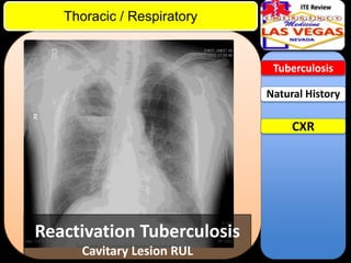 ITE Review

Thoracic / Respiratory

Tuberculosis

Natural History

CXR

Reactivation Tuberculosis
Cavitary Lesion RUL

 