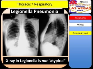 ITE Review

Thoracic / Respiratory

Legionella Pneumonia
Pneumonia

Mimics

Typical/ Atypical

X-ray in Legionella is not “atypical”

 
