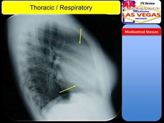 ITE Review

Thoracic / Respiratory

Mediastinal Masses

 
