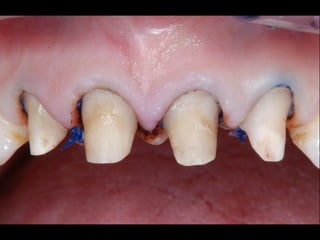 3D Progress MHT 
! 
! 
! 
System 
type 
: 
Chairside 
digital 
impression 
Architecture 
: 
Open 
Powder 
: 
NO/YES 
(Yes 
on 
metals) 
Lab 
Equipment 
: 
3Shape, 
Dental 
Wings, 
Dent 
CAD 
Case 
Delivery 
: 
Doctor 
(Margin 
Marking) 
> 
Laboratory 
Web 
interface 
Case 
Type 
: 
Scan 
Only 
Materials 
: 
3rd 
party 
Zirconia, 
Wax, 
e.Max 
CAD, 
Chrome-­‐cobalt 
Special 
Features 
: 
 
