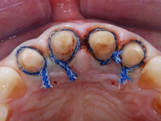 Clon3D Progress IODIS 
! 
! 
! 
System 
type 
: 
Chairside 
digital 
impression 
Architecture 
: 
Open 
Powder 
: 
NO/YES 
(Yes 
on 
metals) 
Lab 
Equipment 
: 
3Shape, 
Dental 
Wings, 
Dent 
CAD 
Case 
Delivery 
: 
Doctor 
(Margin 
Marking) 
> 
Laboratory 
Web 
interface 
Case 
Type 
: 
Scan 
Only 
Materials 
: 
3rd 
party 
Zirconia, 
Wax, 
e.Max 
CAD, 
Chrome-­‐cobalt 
Special 
Features 
: 
 