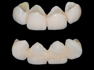 iTero Cadent 
! 
! 
! 
System 
type 
: 
Chairside 
digital 
impression 
Architecture 
: 
Open 
Powder 
: 
NO 
Lab 
Equipment 
: 
Cadent 
Lab 
SoHware 
> 
3Shape, 
Dental 
Wings, 
Dent 
CAD 
Case 
Delivery 
: 
Doctor 
> 
Margin 
Marking 
> 
Milling 
Center 
> 
Laboratory 
Web 
interface, 
E-­‐mail, 
FTP, 
Sneaker-­‐net 
Case 
Type 
: 
Scan 
Only 
Materials 
: 
3rd 
party 
Zirconia, 
Wax, 
e.Max 
CAD, 
Chrome-­‐cobalt 
Special 
Features 
: 
Margin 
line 
extension 
 