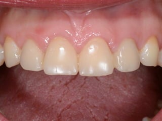 preparation 
impression 
traditional 
stone model 
Waxing 
(Casting) 
Ceramic layering 
Finishing 
 