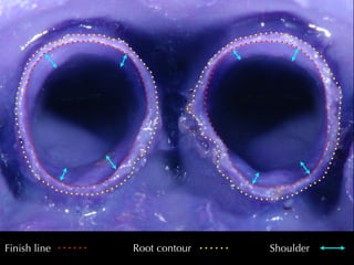 Virtual model 
1. Op)cal 
impression 
! 
2. Laser 
scan 
of 
the 
stone 
model 
! 
3. Op)cal 
scan 
of 
the 
stone 
model 
 
