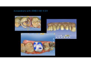 Screenshots with CEREC SW 4.0.4 
 