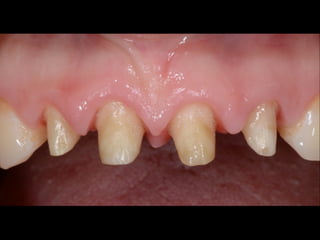 Optical impression 
Optical technology Laser technology 
C.O.S. (3M Espe) 
! 
Fast Scan (IOS Technologies) 
! 
Intraoral camera (Densys3D) 
! 
Cerec Bluecam (Sirona) 
E4D (D4D Technologies) 
! 
iTero (Cadent) 
! 
3D Progress (MHT) 
 