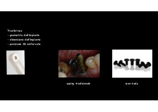 43 
Trasferisce 
- geometria dell’impianto 
- dimensione dell’impianto 
- posizione 3D nell’arcata 
! 
! 
! 
! 
! 
! 
! 
! 
coping tradizionale scan body 
 