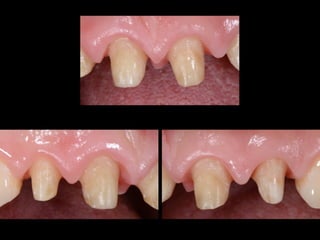 Optical Technology 
CCD - CMOS 
Acquisition of static or dynamic images that with different 
imaging using algorythm are meta-ricombined modeling a three-dimensional 
virtual images 
Laser Technology (Confocal technique) 
LASER 
Laser beam is convergent in small spots and with an array of 
oscillating mirrors laser is moved through the entire 
observation field for scanning all focal planes. 
 