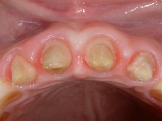 3M - C.O.S. 
! 
! 
! 
System 
type 
: 
Chairside 
CAD/CAM 
Architecture 
: 
Selec)vely 
OpenClosed* 
Powder 
: 
Yes 
? 
Lab 
Equipment 
: 
COS 
soHware 
, 
LavaDesign, 
3Shape, 
Dental 
Wings 
Case 
Delivery 
: 
Doctor 
> 
Margin 
Making 
> 
Milling 
Center 
> 
Laboratory 
Web 
Interface, 
E-­‐mail. 
FTP, 
Sneaker-­‐net 
Case 
Type 
: 
Scan 
Only 
Materials 
: 
LAVA, 
3rd 
party 
Zirconia, 
LAVA 
DVS, 
Wax, 
e.Max 
CAD, 
Chrome-­‐cobalt 
Special 
Features 
: 
3D 
margin 
making, 
Scan 
file 
edi)ng, 
(wax 
on 
/wax 
off) 
 